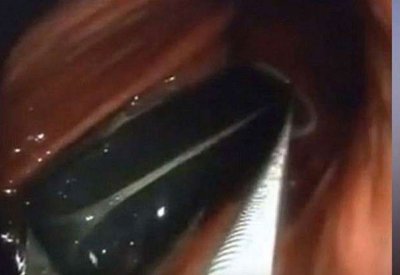 استخراج ولاعة ابتلعها صيني قبل 20 عاما