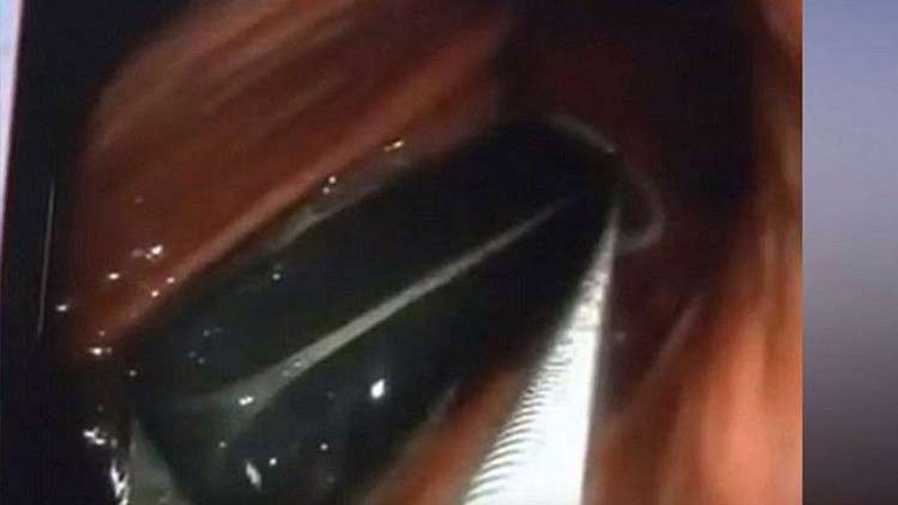 استخراج ولاعة ابتلعها صيني قبل 20 عاما