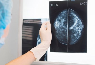 في سابقة عالمية..العلاج المناعي يشفي مصابة بسرطان الثدي