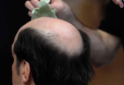  8 أسباب "غير مألوفة" لتساقط الشعر