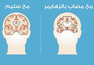  لقاح جديد للقضاء على مرض ألزهايمر