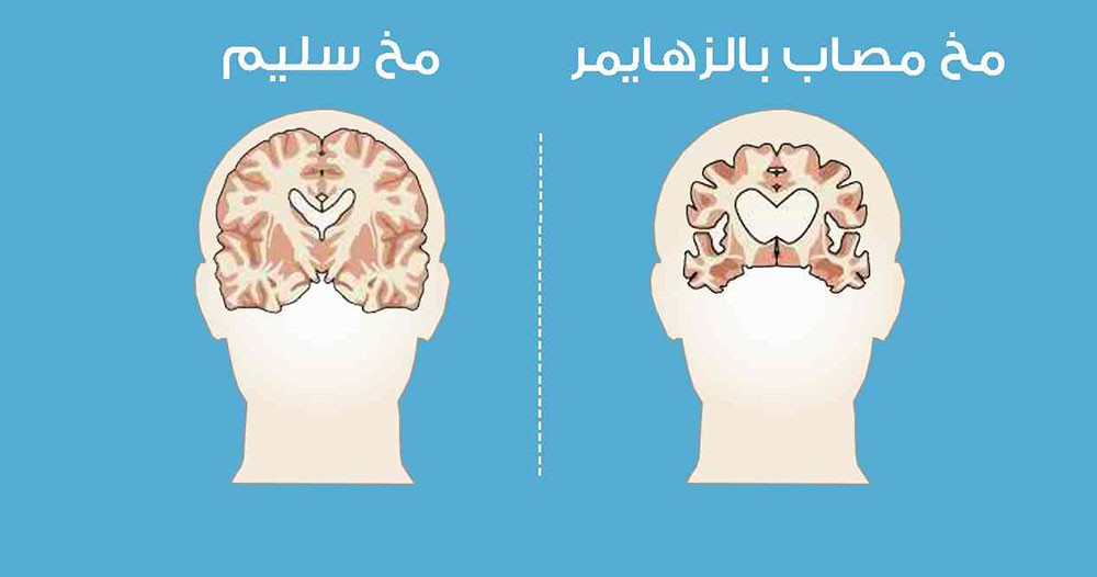  لقاح جديد للقضاء على مرض ألزهايمر