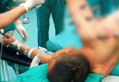 روبوت صناعي يغرز 10 قضبان معدنية في جسد عامل
