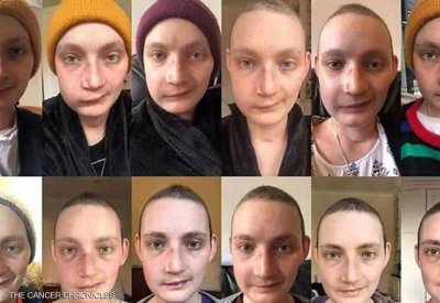  ناجية توثق رحلة شفائها من السرطان.. صور قبل وبعد بناء الوجه