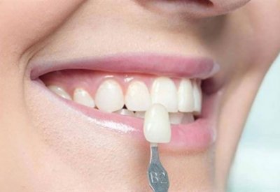 عدسات الأسنان اللاصقة.. حل تجميلي بتكلفة باهظة