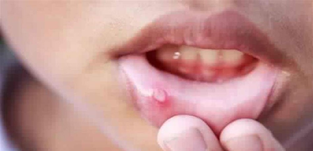 من بينها السرطان.. علامات تظهر بالفم تشير أنك على وشك الإصابة بأمراض خطيرة