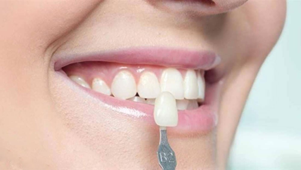 عدسات الأسنان اللاصقة.. حل تجميلي بتكلفة باهظة