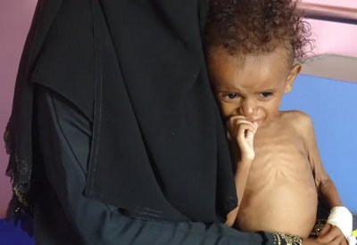 50 مليون شخص في المنطقة يعانون من "نقص التغذية"