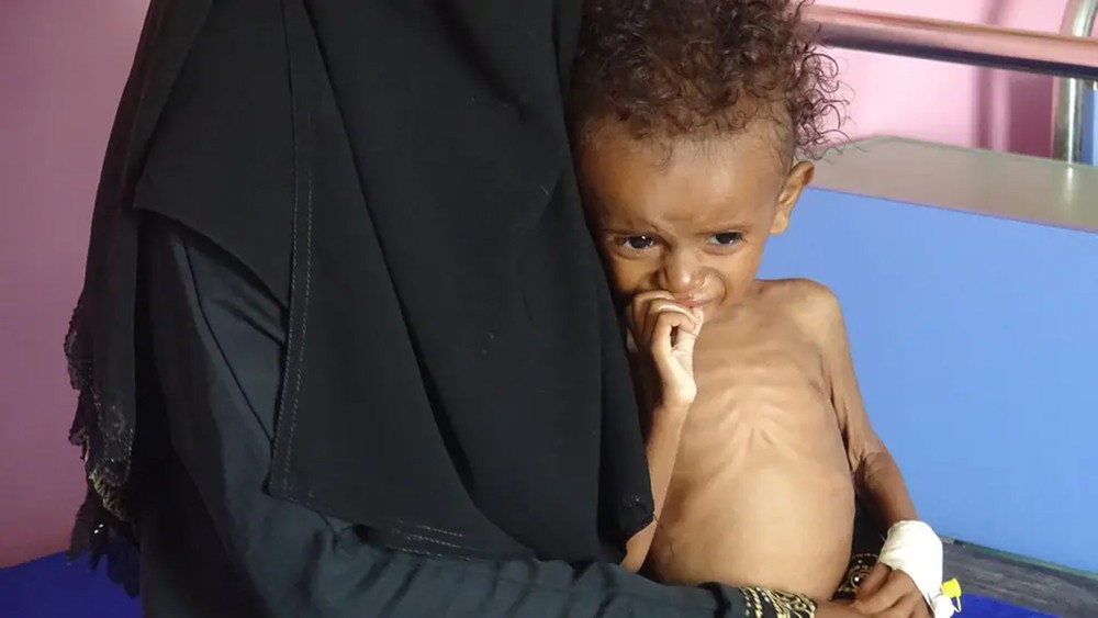 50 مليون شخص في المنطقة يعانون من "نقص التغذية"