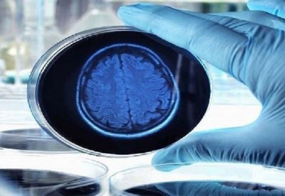 اكتشاف جديد يعطي أملا لعلاج الأعراض المبكرة لمرض ألزهايمر
