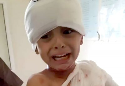 صورة تفطر القلوب.. طفل يمني مصاب بشظايا حوثية