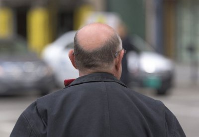 هل تعتبر "زراعة الشعر" حلا لمشكلة الصلع
