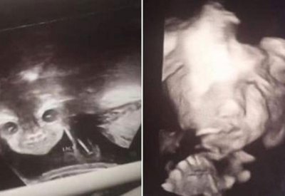  "الجنين الشيطان" يثير قلق والديه.. والطب يوضح الحقيقة 