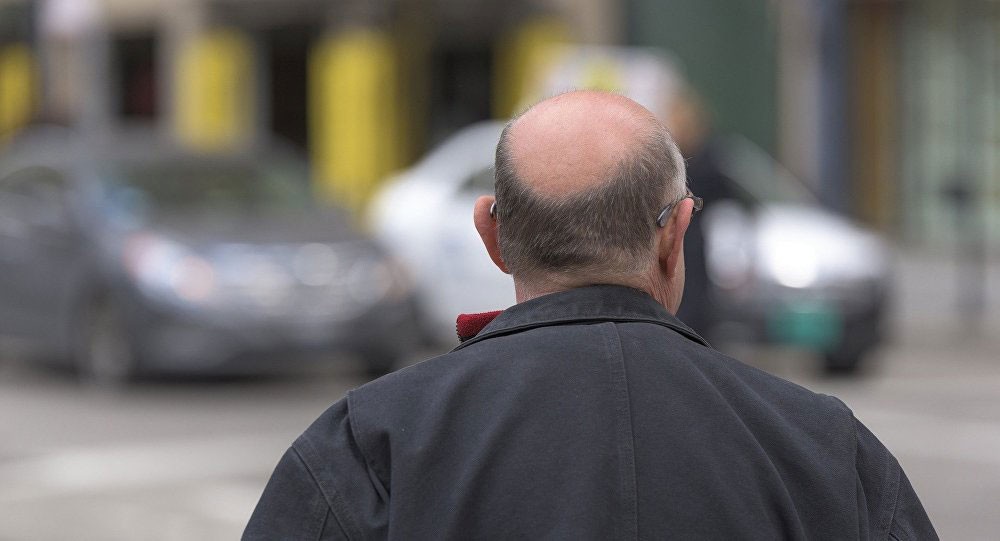 هل تعتبر "زراعة الشعر" حلا لمشكلة الصلع