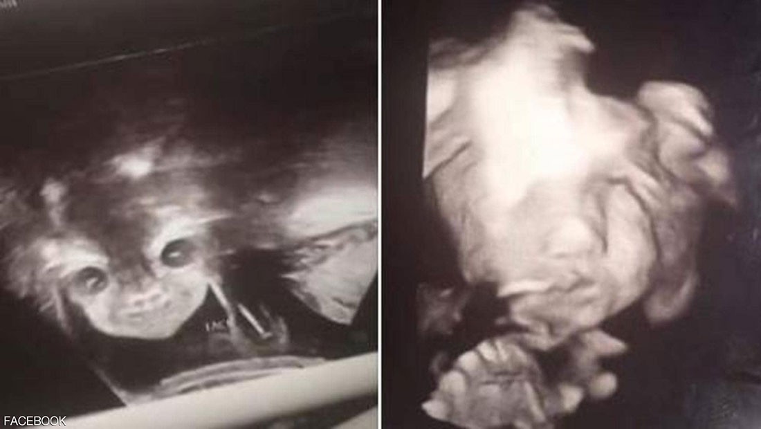  "الجنين الشيطان" يثير قلق والديه.. والطب يوضح الحقيقة 