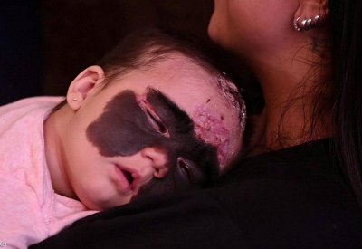  "رضيعة باتمان" التي أثارت تعاطف العالم تبدأ رحلة العلاج 