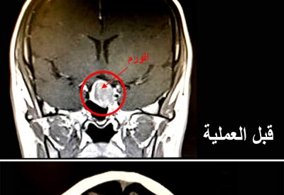 مستشفى الملك حمد يستأصل ورم من رأس إمرأة بحرينية عن طريق الأنف