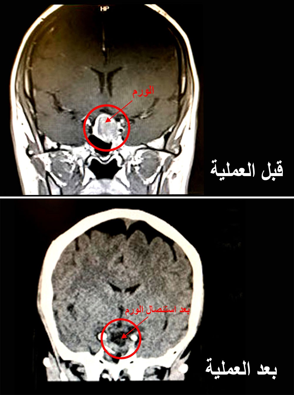 مستشفى الملك حمد يستأصل ورم من رأس إمرأة بحرينية عن طريق الأنف