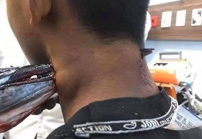 سمكة الإبرة قفزت من المياه.. واخترقت رقبة محمد