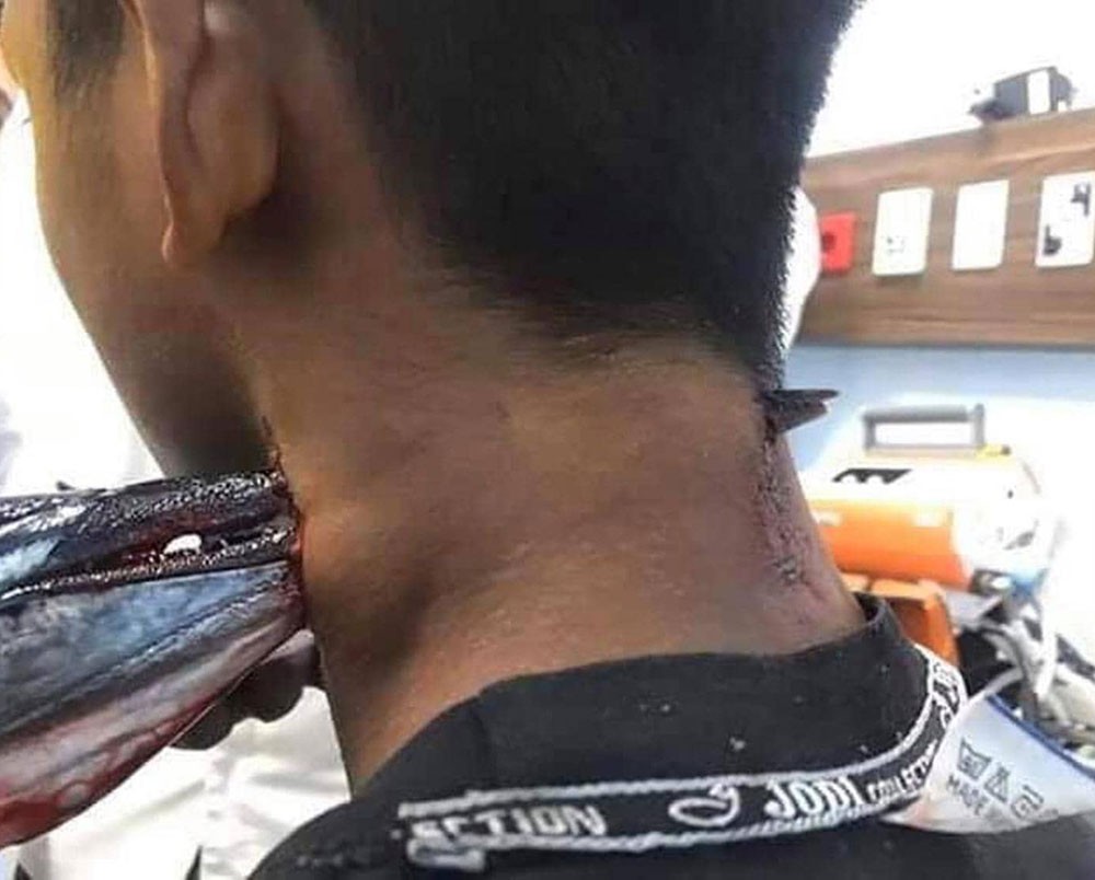 سمكة الإبرة قفزت من المياه.. واخترقت رقبة محمد