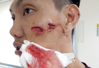 الاعتداء على مقيم فلبيني بلوح خشبي من شخص مجهول