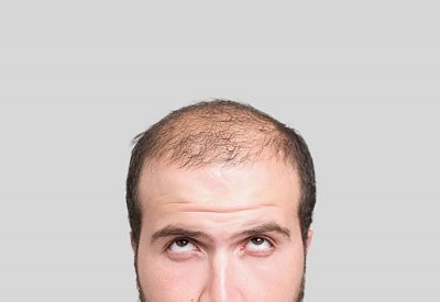 الصلع من أخطر عوامل الإصابة بكورونا !