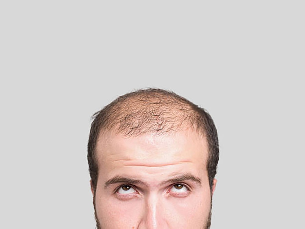 الصلع من أخطر عوامل الإصابة بكورونا !