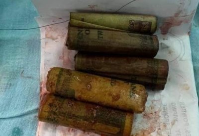 بالصور: لن تصدق ما سترى.. آلاف الجنيهات خرجت من بطن مصري