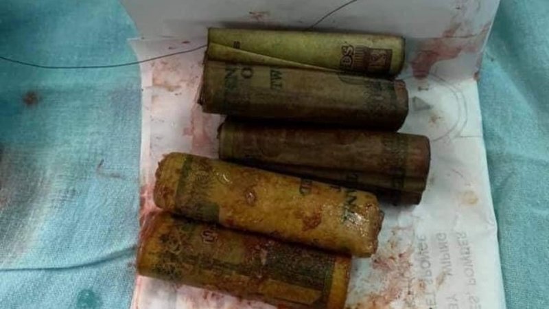 بالصور: لن تصدق ما سترى.. آلاف الجنيهات خرجت من بطن مصري