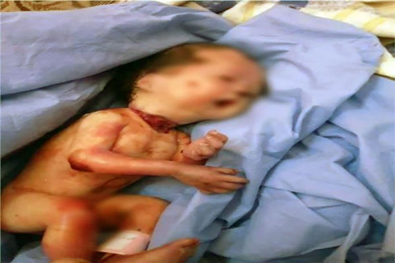 ولادة نادرة لطفل مذبوح