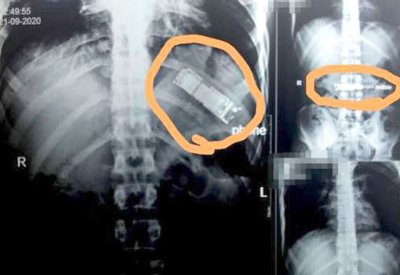 هاتف محمول استقر في معدة مصري 7 أشهر