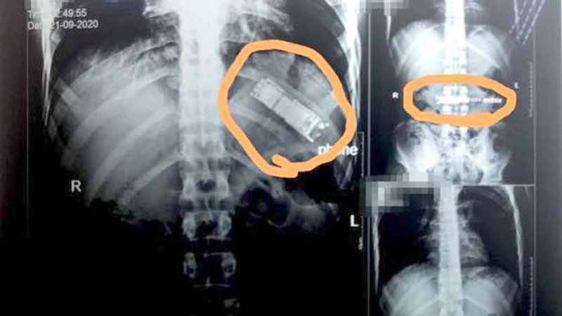 هاتف محمول استقر في معدة مصري 7 أشهر