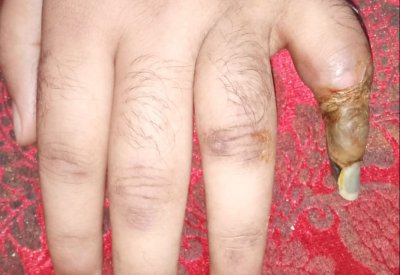 ثلاثيني يقطع خنصره.. ويناشد لإجراء عملية في عينه ليرى