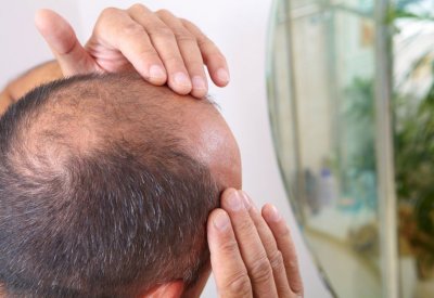 علماء ينجحون في علاج الصلع في 90 دقيقة