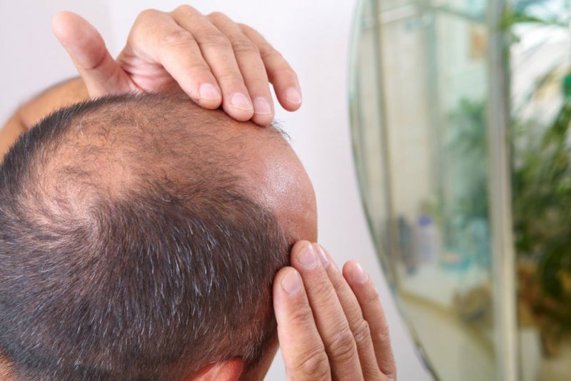علماء ينجحون في علاج الصلع في 90 دقيقة