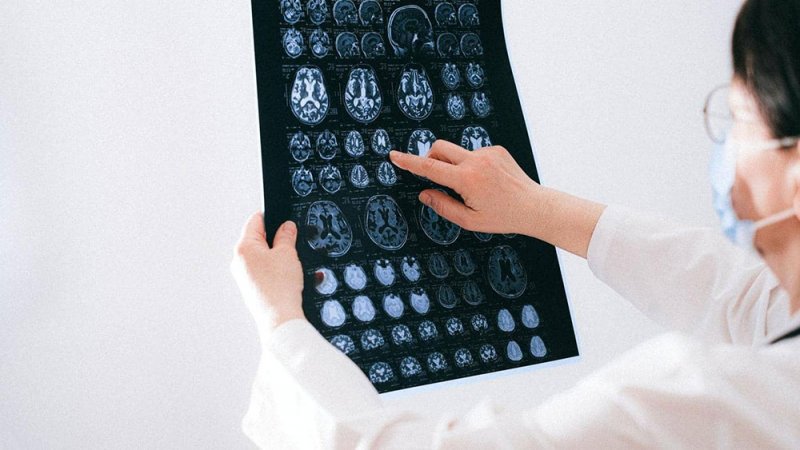 ماذا تعرف عن "المادة البيضاء" في الدماغ؟