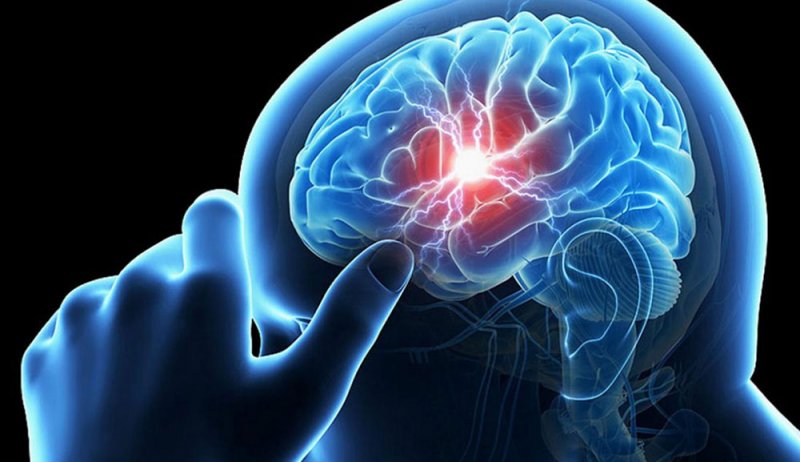 هكذا يمكن تقليل احتمالات الإصابة بسكتة دماغية