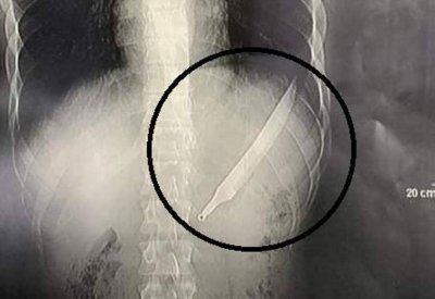 مصري يبتلع سكينا طوله 27 سنتيمترا.. والأطباء يصنعون معجزة
