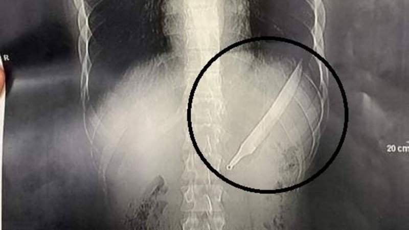 مصري يبتلع سكينا طوله 27 سنتيمترا.. والأطباء يصنعون معجزة