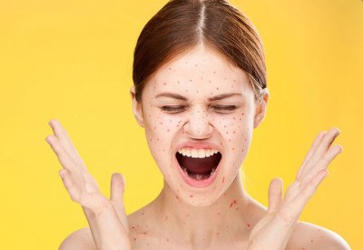 هذه الأخطاء تتسبب بتفاقم مشكلة البثور الطارئة