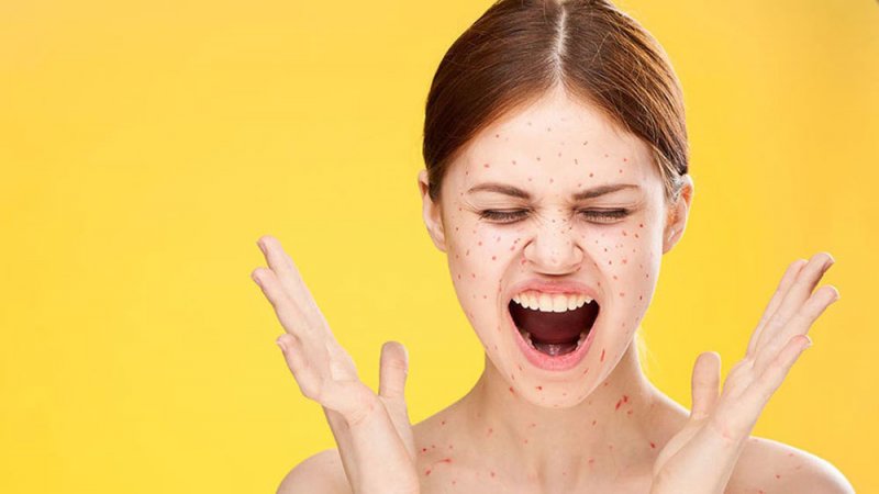 هذه الأخطاء تتسبب بتفاقم مشكلة البثور الطارئة
