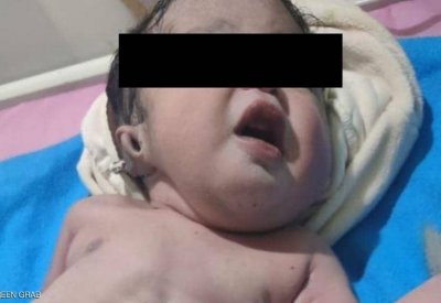 "من دون بطن".. تفاصيل ولادة "ووفاة" طفل بحالة نادرة في مصر