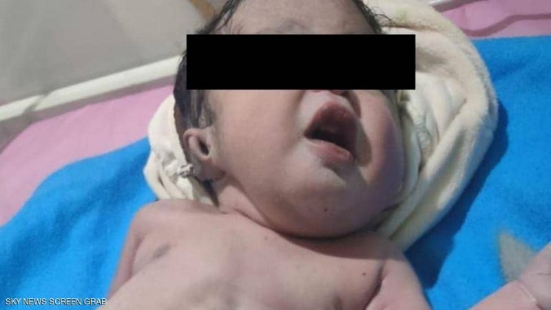 "من دون بطن".. تفاصيل ولادة "ووفاة" طفل بحالة نادرة في مصر