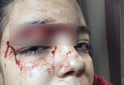 بالصور: رفضت الزواج منه فشق جمجمتها بساطور وفتت عظام يدها