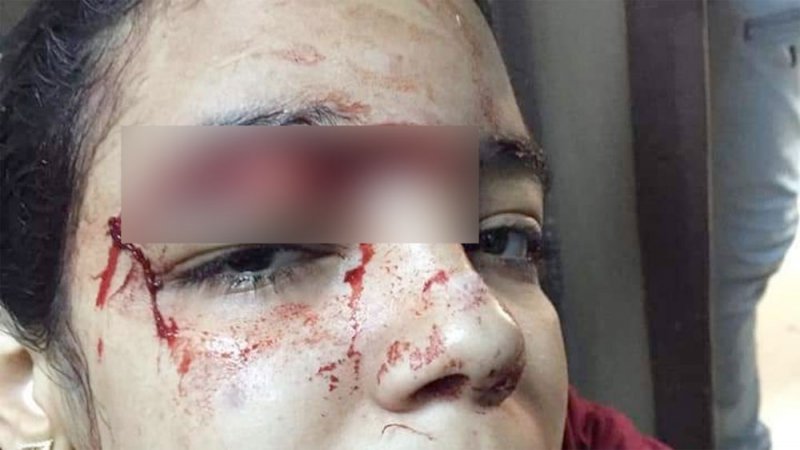 بالصور: رفضت الزواج منه فشق جمجمتها بساطور وفتت عظام يدها