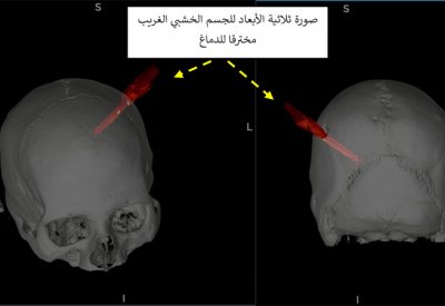 طاقم جراحة المخ والأعصاب بمجمع السلمانية الطبي‏ ينقذ حياة رجل إثر إصابة بليغة في الدماغ