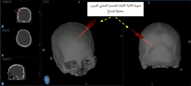طاقم جراحة المخ والأعصاب بمجمع السلمانية الطبي‏ ينقذ حياة رجل إثر إصابة بليغة في الدماغ