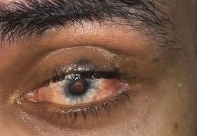 بالصور: قصته تفطر القلب.. بادر بتفكيك ألغام الحوثي ففقد عينه وبترت أطرافه