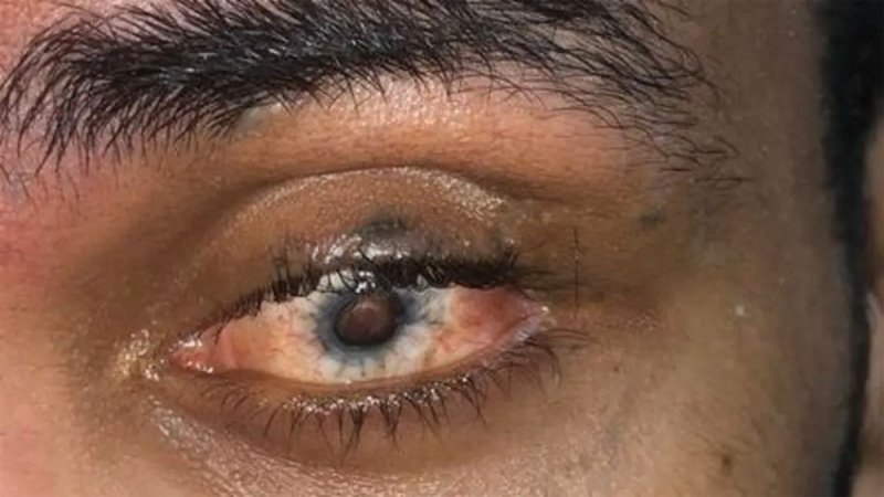 بالصور: قصته تفطر القلب.. بادر بتفكيك ألغام الحوثي ففقد عينه وبترت أطرافه