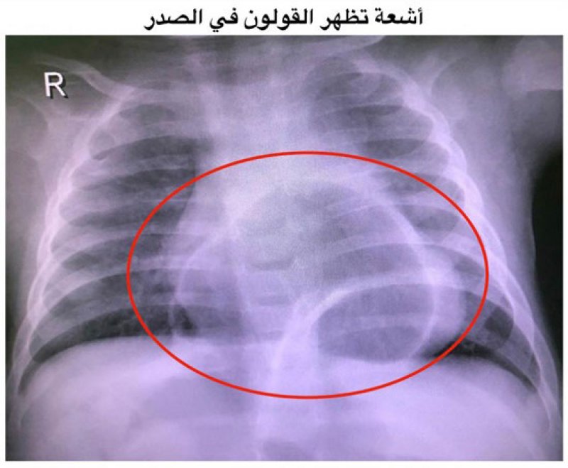 المستشفى العسكري ينجح في إجراء عملية منظار لإصلاح فتق بالحجاب الحاجز لدى رضيعة